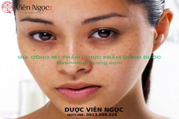 Nước hoa, mỹ phẩm: Gia công mỹ phẩm điều trị nám tàn nhang trọn gói với Dược Viê %E1%BA%A3nh-01-1_result-600x400