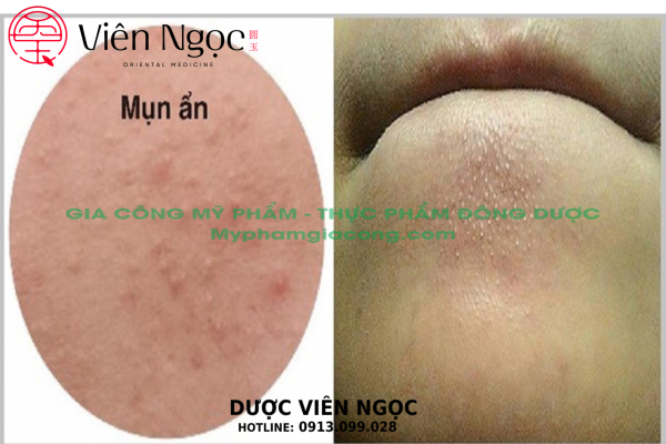 Nước hoa, mỹ phẩm: Trị mụn hiệu quả của dịch vụ gia công mỹ phẩm trọn gói Dược V %E1%BA%A3nh-06-3_result-600x400