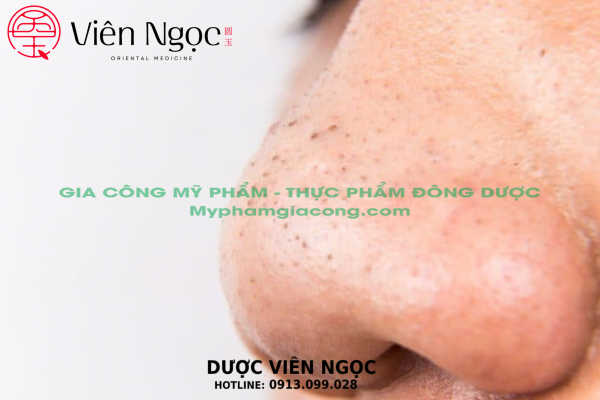 Nước hoa, mỹ phẩm: Trị mụn hiệu quả của dịch vụ gia công mỹ phẩm trọn gói Dược V %E1%BA%A3nh-06-5_result-600x400